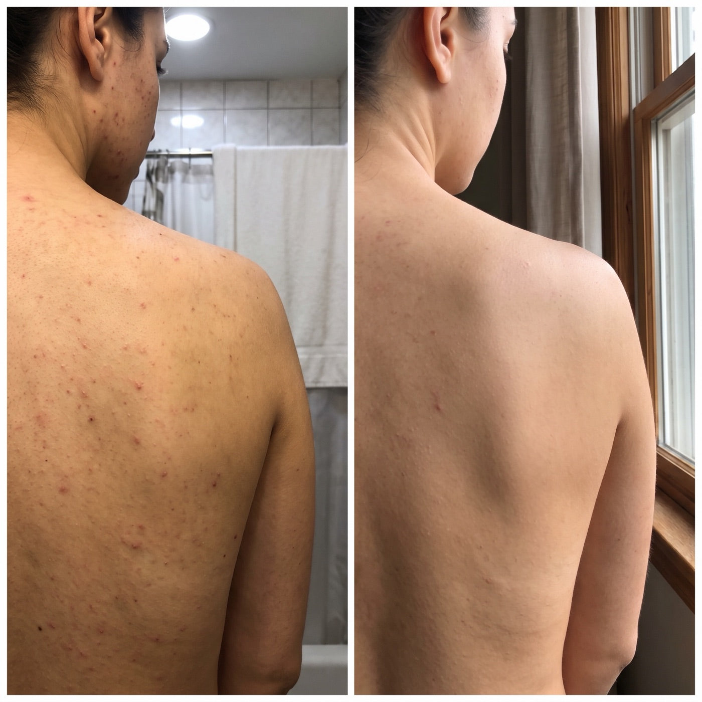 Before and after of back and decollete breakouts at week six