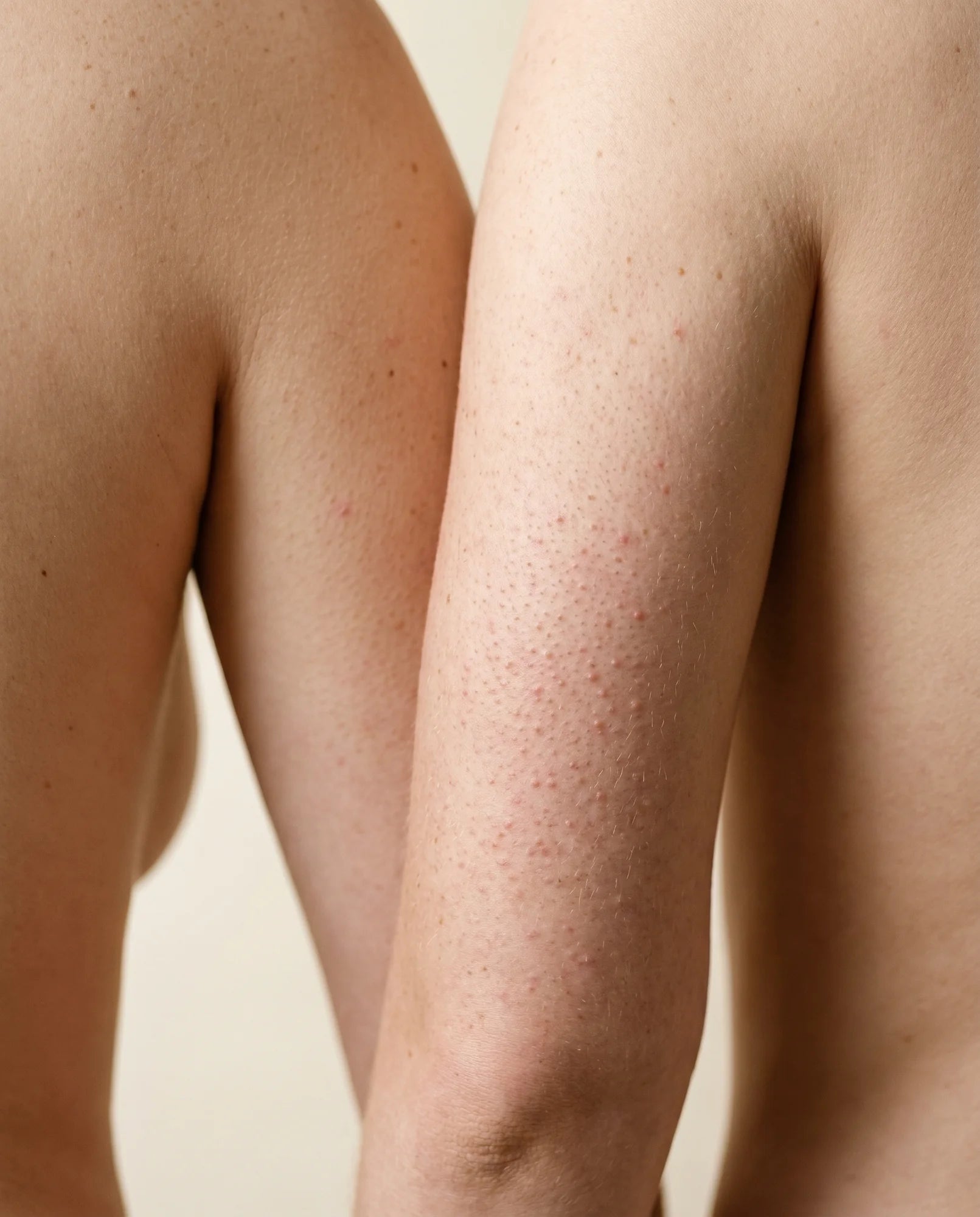 Upper arm with keratosis pilaris before Pebble Serum