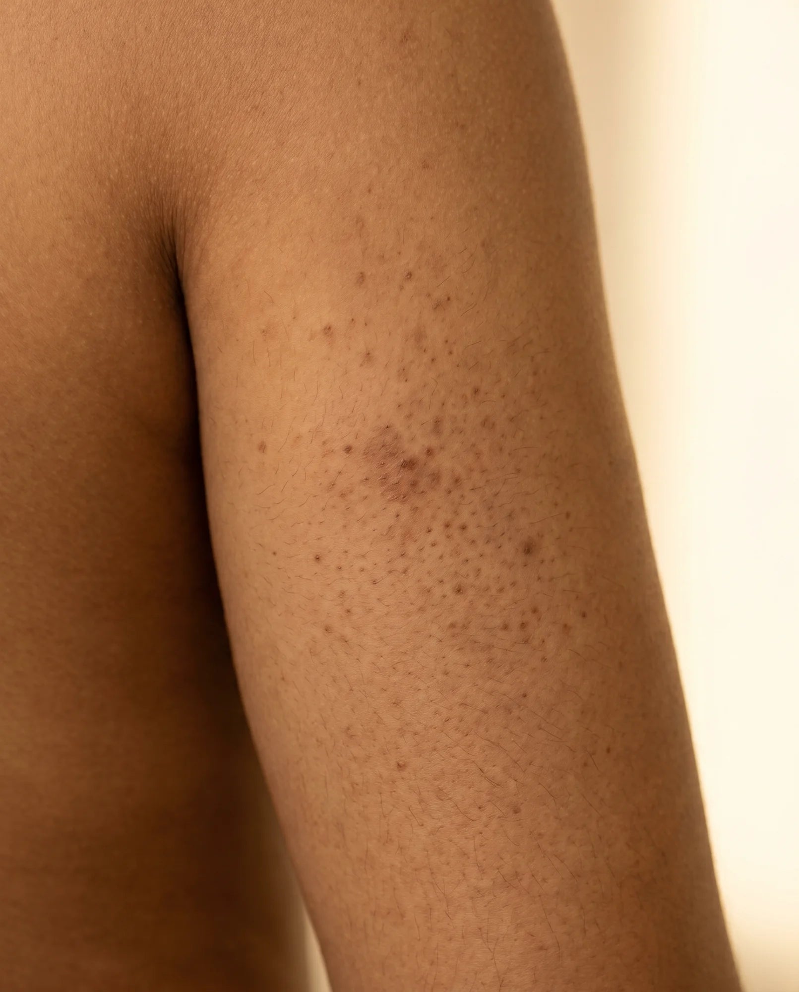 Upper arm with KP and PIH before Pebble Serum