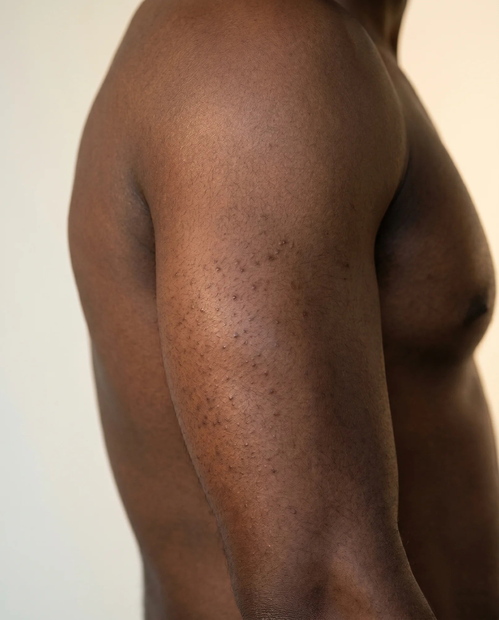Male tricep with KP before Pebble Serum