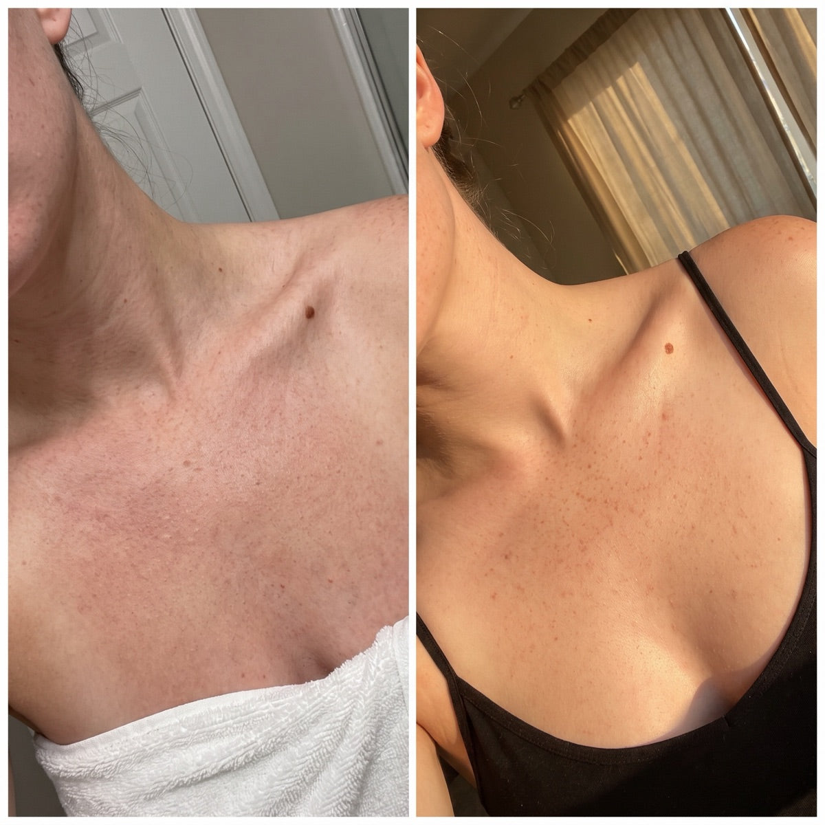 Customer photos of décolleté with freckles, before and after