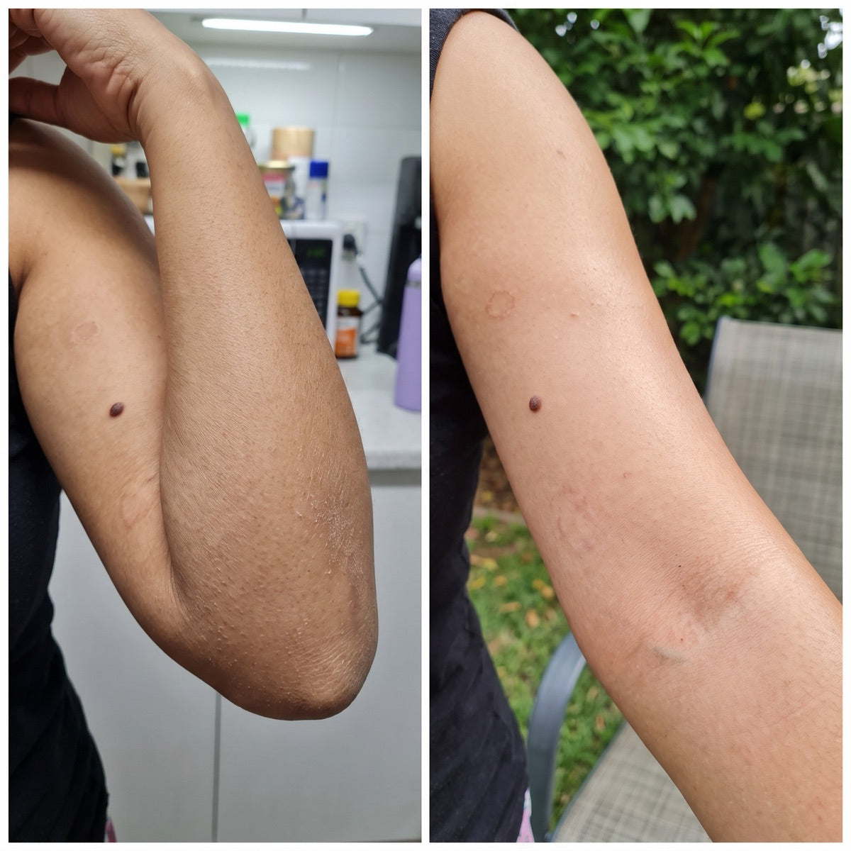 Customer photos of upper arm, before and after