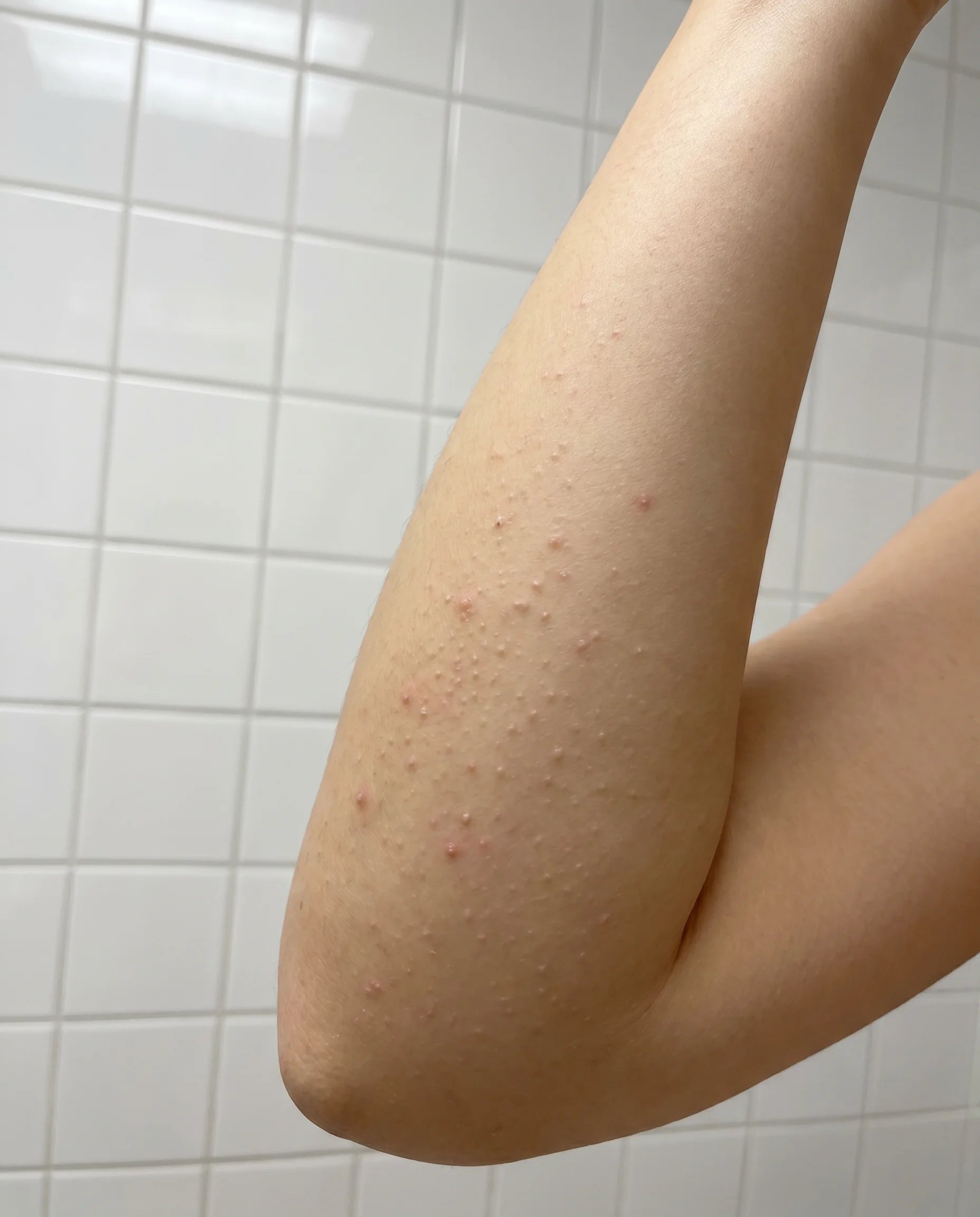 Fair forearm with keratosis pilaris before Pebble Serum