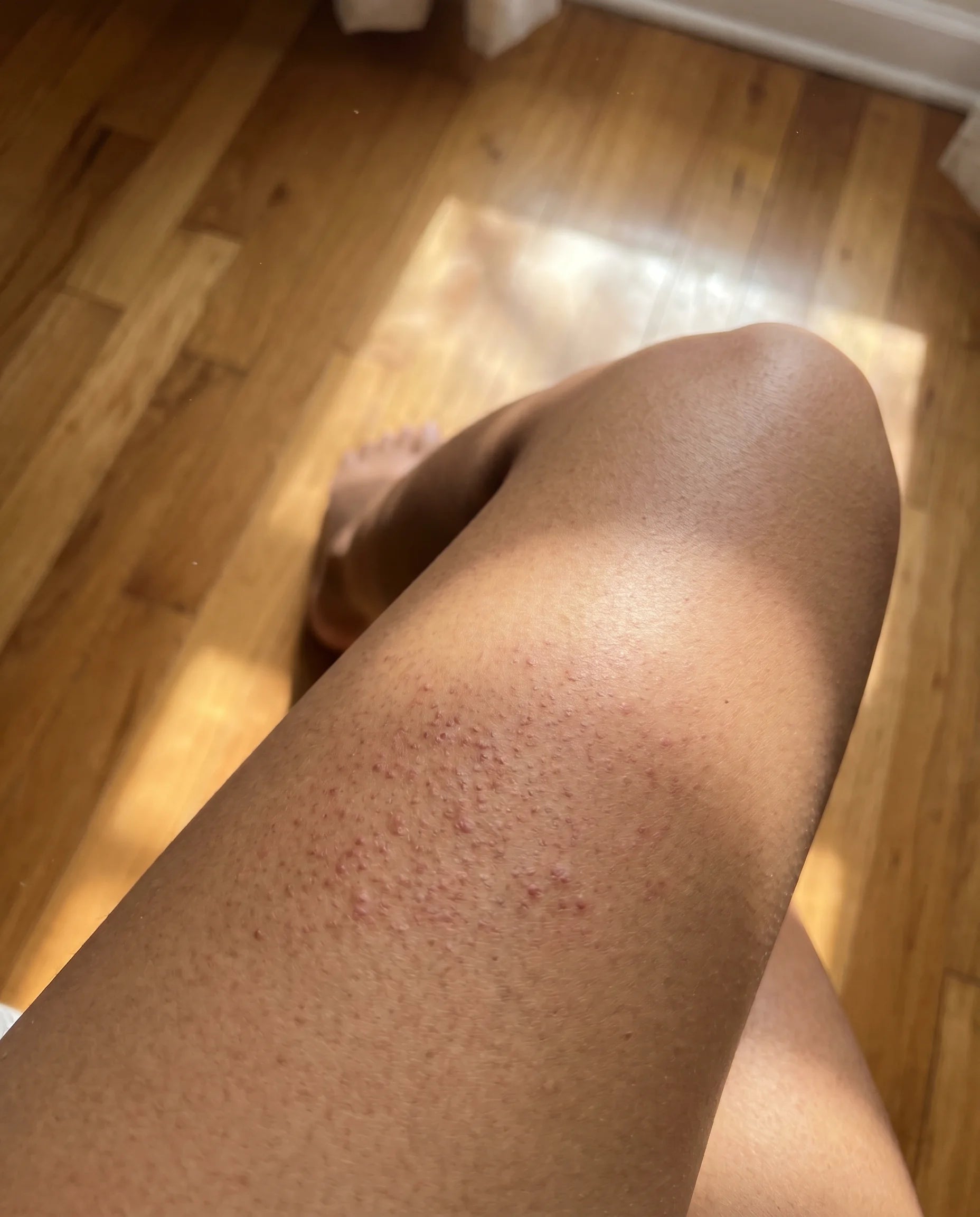 Olive-toned thigh with keratosis pilaris before Pebble Serum