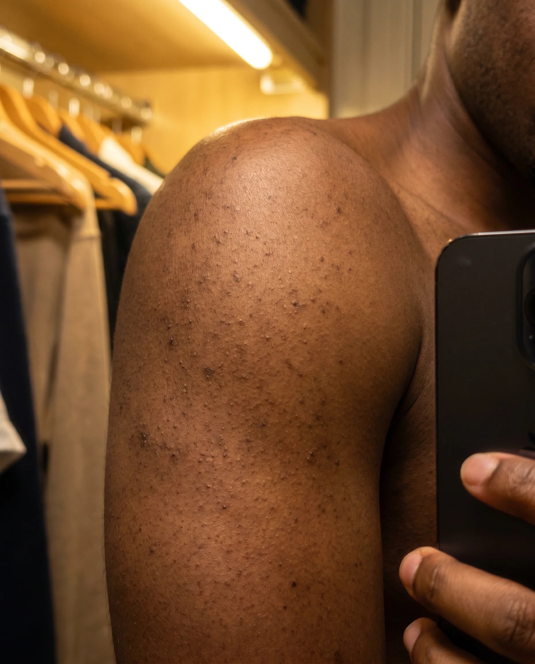 Deep-brown shoulder with keratosis pilaris and PIH before Pebble Serum
