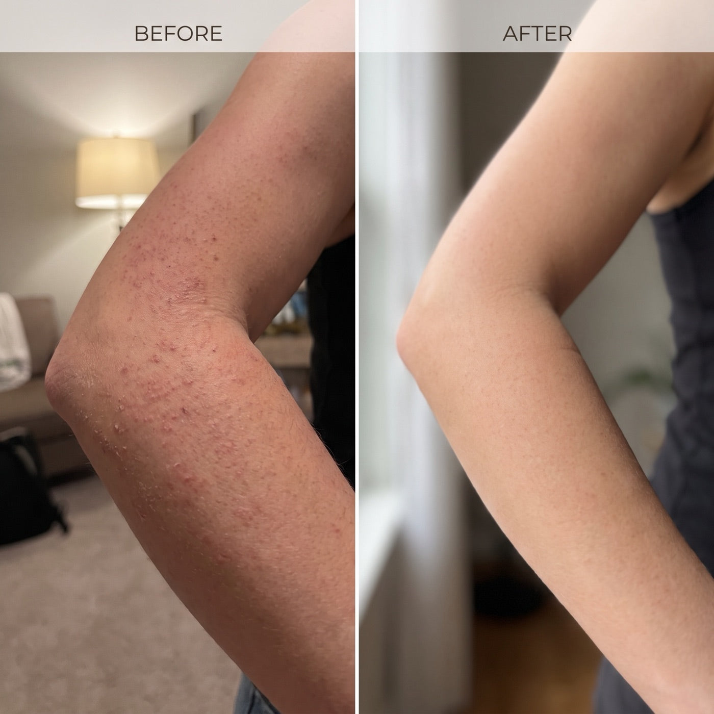 Before and after of upper-arm bumps at week 4